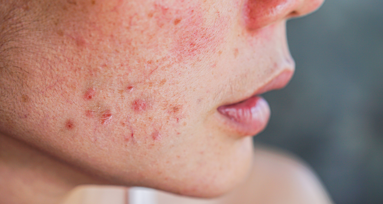 Can a Food Sensitivity Test Help my Acne?