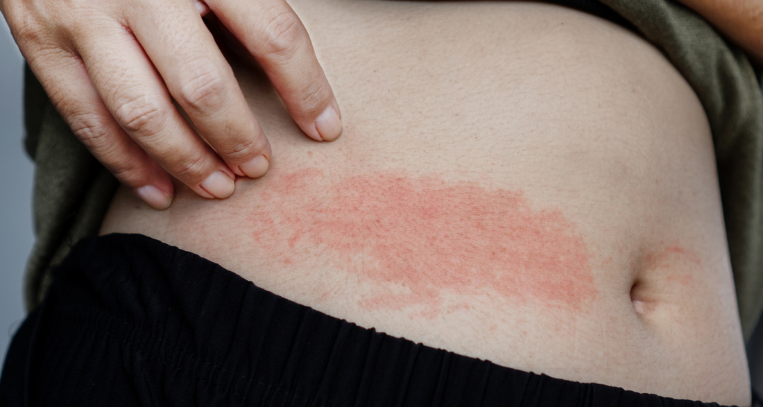 Can Food Sensitivities Affect Your Skin? Understanding the Gut–Skin Connection